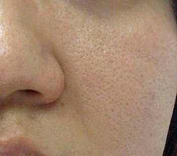 علت باز شدن منافذ پوست صورت چیست ؟ + راه های درمان