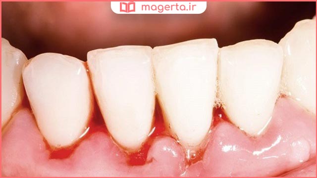 خونریزی لثه هنگام کشیدن نخ دندان