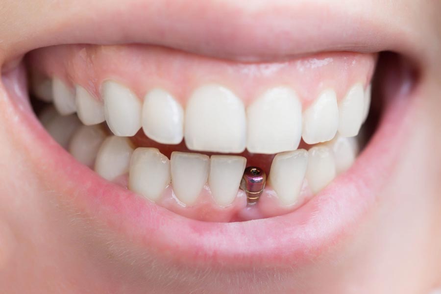 شرایط لازم برای کاشت دندان چیست؟