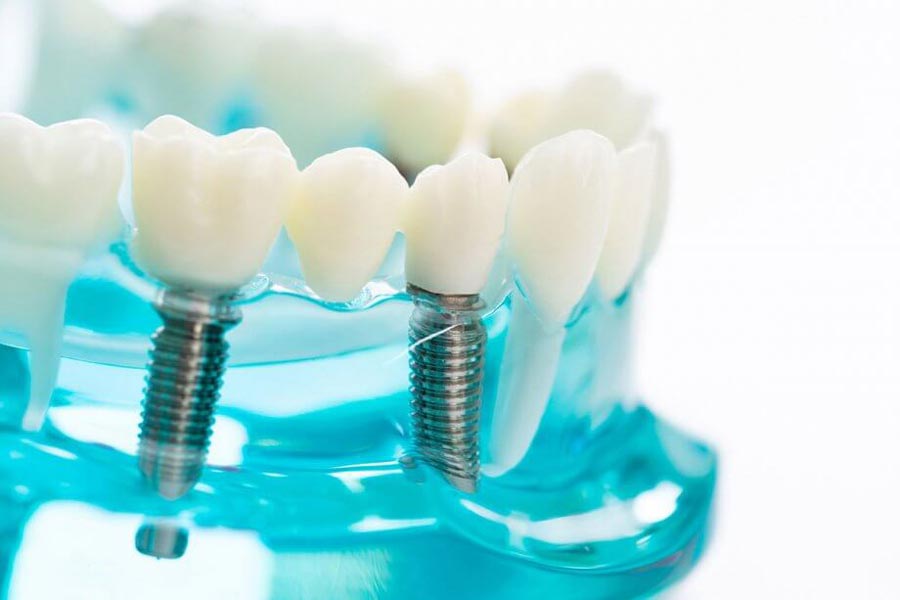 ایمپلنت دندان در افراد زیر 18 سال چگونه است؟