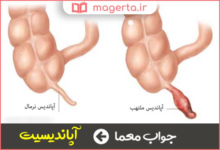 جواب معما التهاب روده کور در جدول