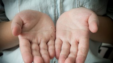 علت پوست پوست شدن انگشتان دست و پا در کودکان