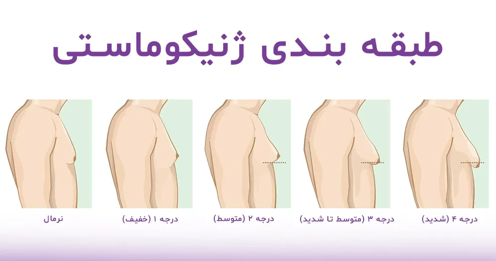 انواع و درجات ژنیکوماستی