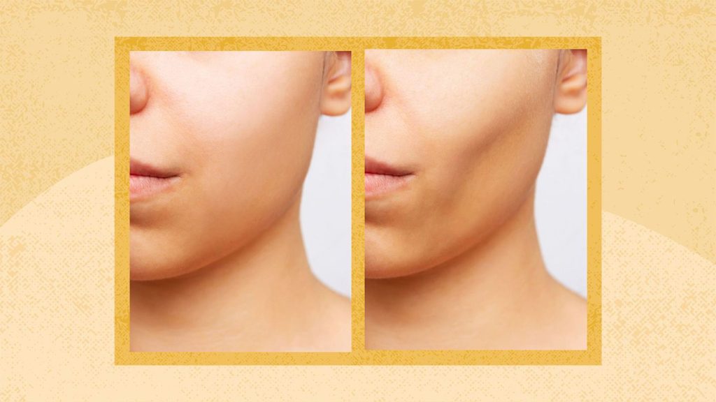 What Is Buccal Fat Removal? Process, Side Effects, Alternatives, and More