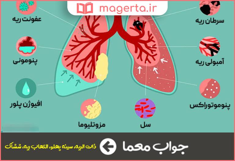 جواب معما بیماری مربوط به التهاب شش در جدول