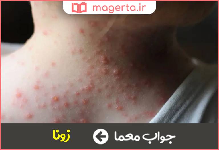 جواب معما یک بیماری ویروسی با عامل آبله مرغان در جدول