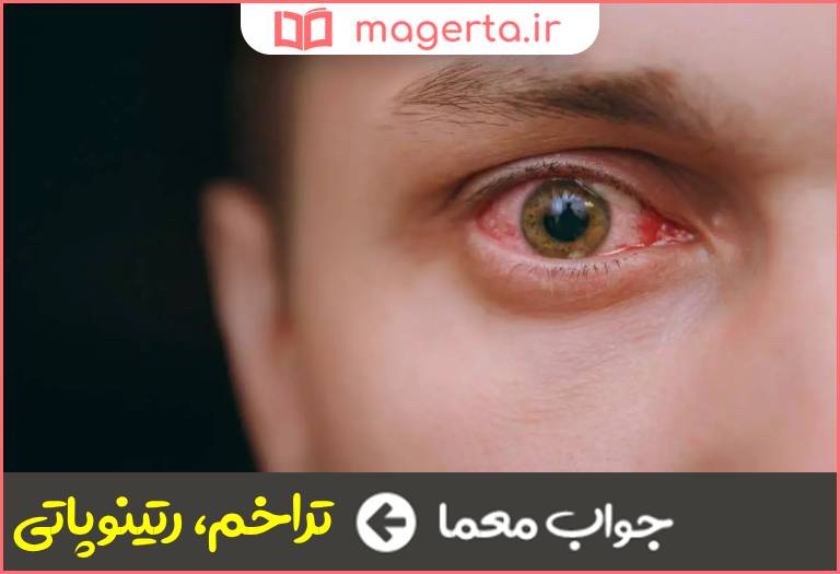 جواب معما از بیماریهای چشم در جدول
