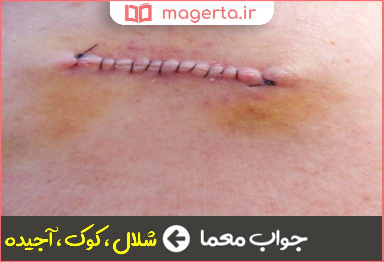 جواب معما بخیه در جدول