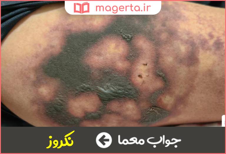 جواب معما مرگ بافت بدن بر اثر انسداد خونرسانی در جدول