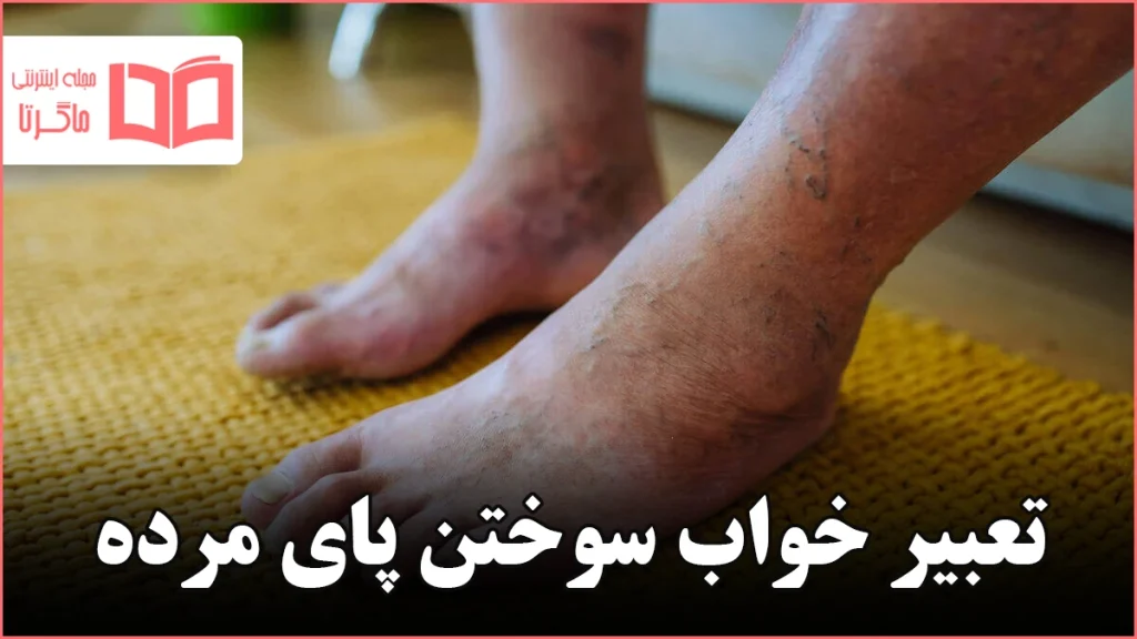 تعبیر خواب سوختن پای مرده