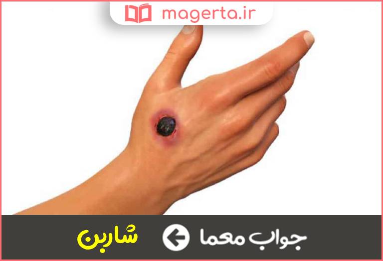 جواب معما سیاه زخم در جدول