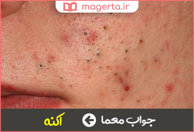 جواب معما نوعی زائده پوستی در جدول