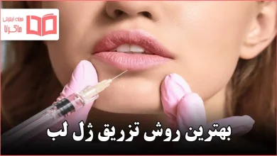 بهترین روش تزریق ژل لب