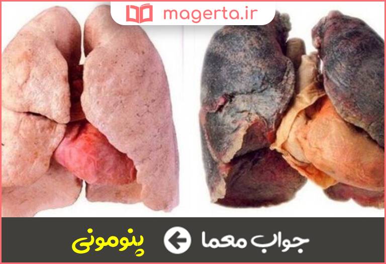 جواب معما بیماری عفونت ریوی در جدول