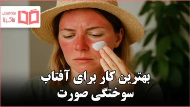 بهترین کار برای آفتاب سوختگی صورت