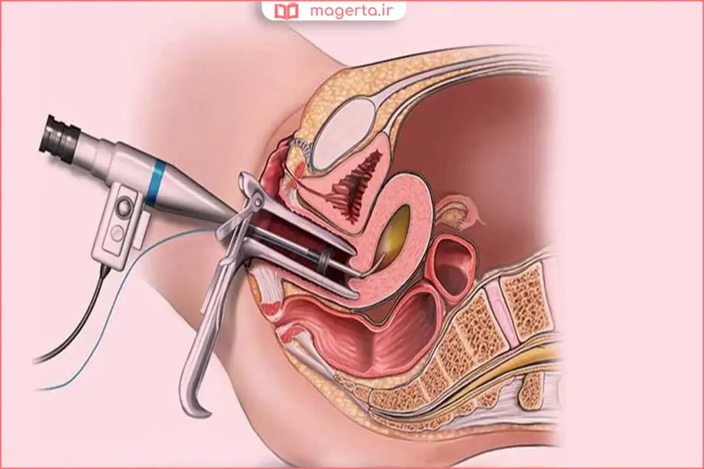 دستگاه تصویربرداری رحم با مواد حاجب برای بررسی سلامت لولههای فالوپ