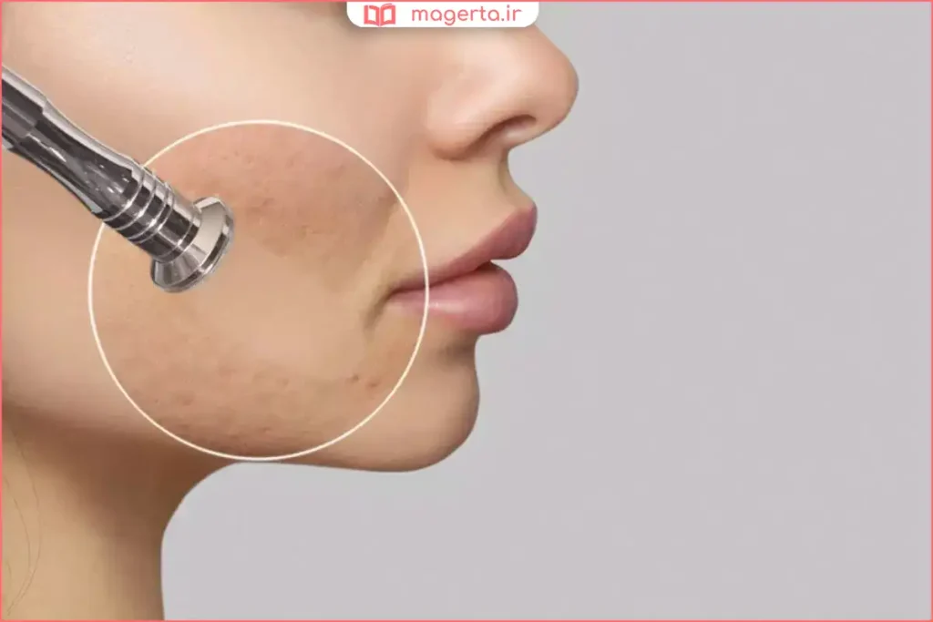 درمان میکرونیدلینگ صورت در کلینیک زیبایی