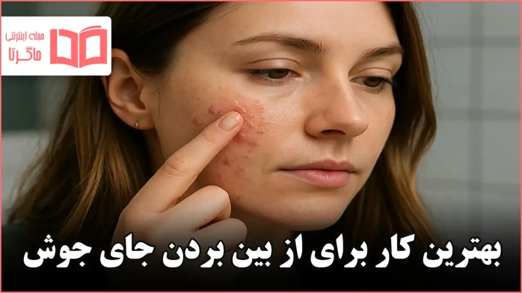 بهترین کار برای از بین بردن جای جوش