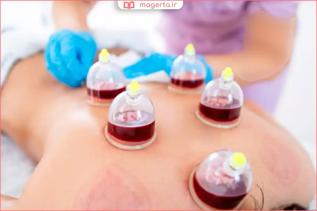 بیمار در حال انجام حجامت برای کم کردن غلظت خون