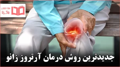 جدیدترین روش درمان آرتروز زانو