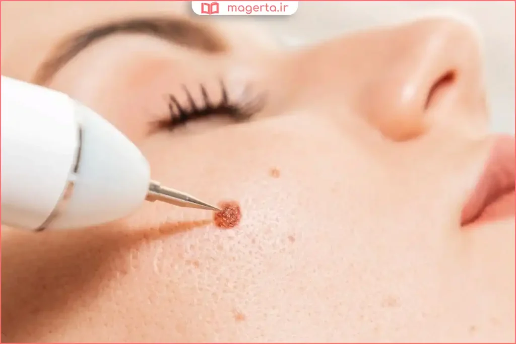 متخصص پوست در حال برداشتن خال صورت با دستگاه لیزر دقیق