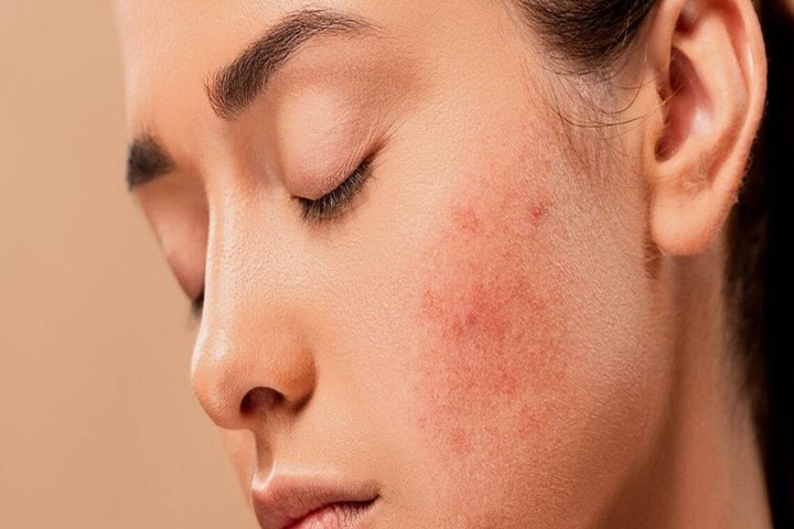 کلینیک زیبایی سعادت آباد برای رفع لک صورت کجا بریم