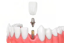 ایمپلنت کره ای