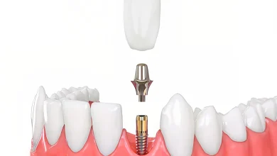 ایمپلنت کره ای