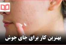 بهترین کار برای جای جوش