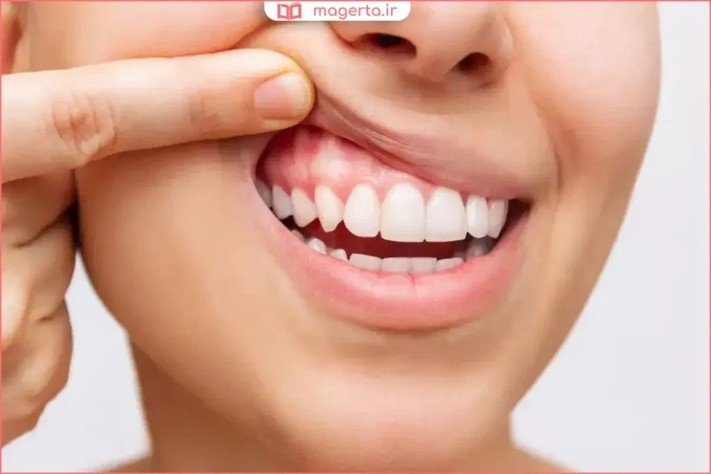 لثه قرمز و متورم به دلیل التهاب و عفونت