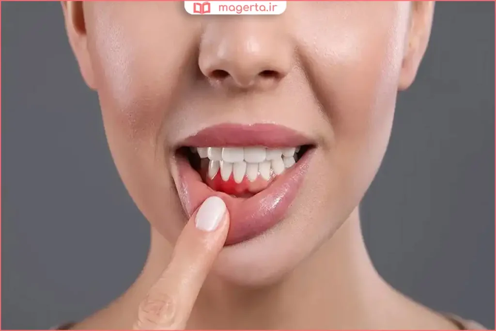 نمای نزدیک از لثه‌های خونریزی‌دهنده ناشی از عفونت