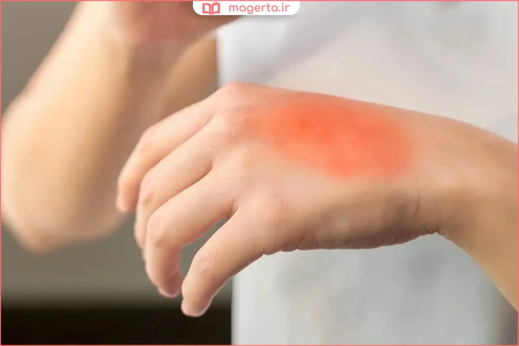 قرار دادن دست سوخته زیر آب خنک برای کاهش درد و التهاب