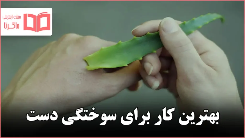 بهترین کار برای سوختگی دست