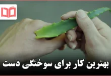 بهترین کار برای سوختگی دست