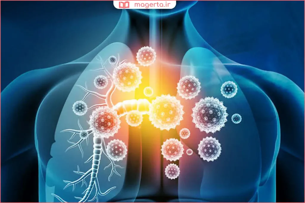تصویربرداری از قفسه سینه نشاندهنده التهاب و عفونت ریه
