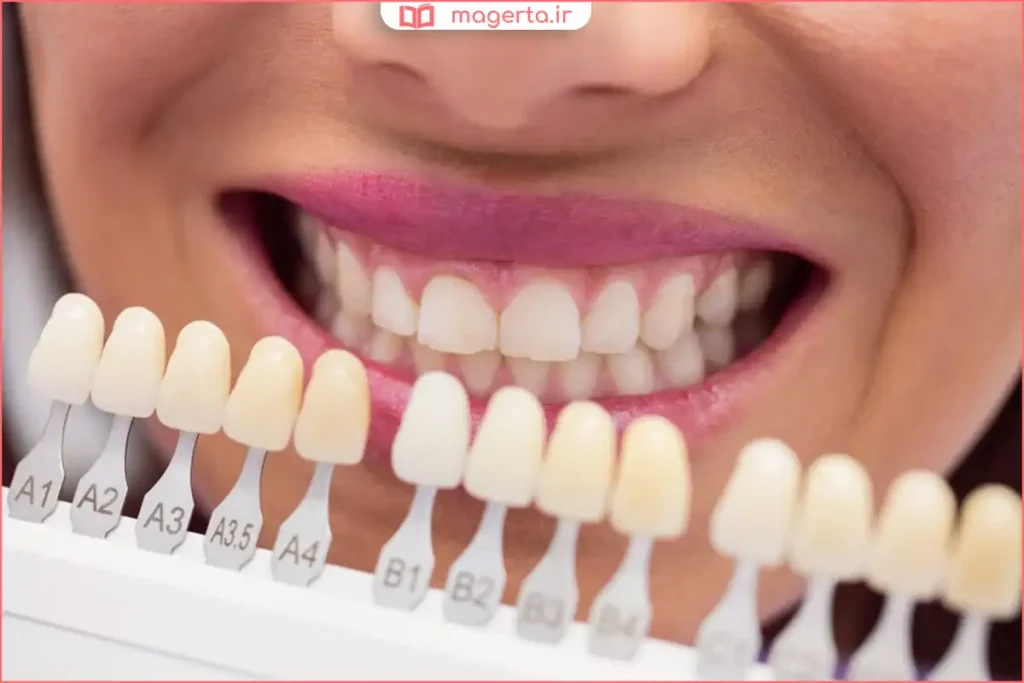 دندان‌پزشک در حال تطبیق رنگ کامپوزیت با رنگ دندان طبیعی بیمار