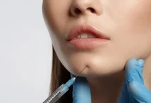 تزریق چربی به صورت چقدر ماندگاری دارد؟