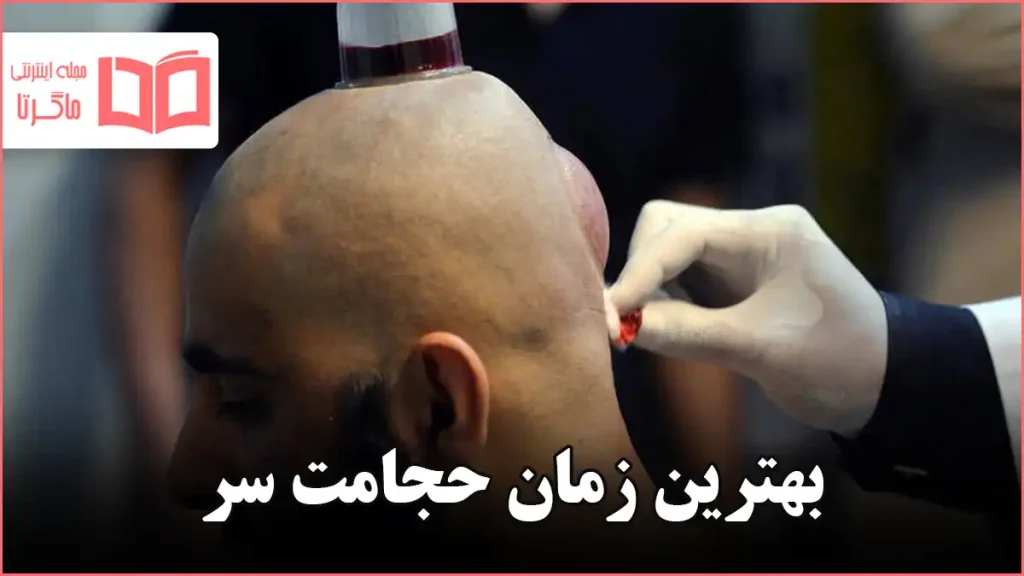 بهترین زمان حجامت سر