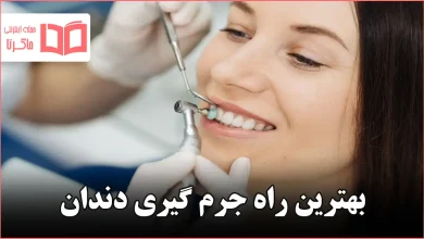 بهترین راه جرم گیری دندان