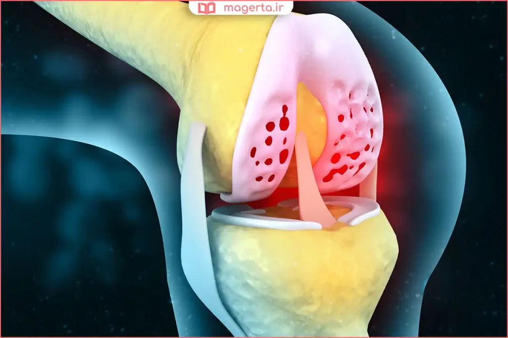 بررسی مفصل زانو در روند بهبود و غضروفسازی