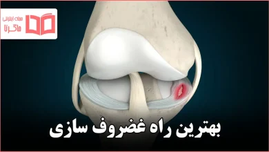 بهترین راه غضروف سازی