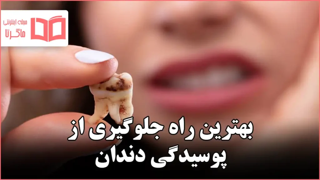 بهترین راه جلوگیری از پوسیدگی دندان