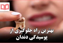 بهترین راه جلوگیری از پوسیدگی دندان