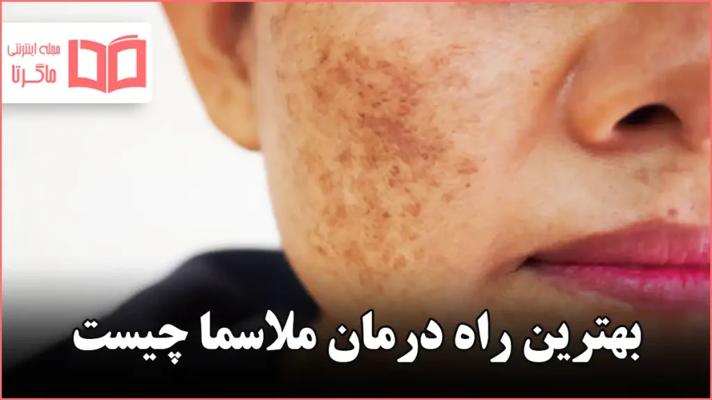 بهترین راه درمان ملاسما چیست