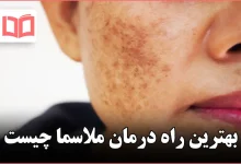 بهترین راه درمان ملاسما چیست