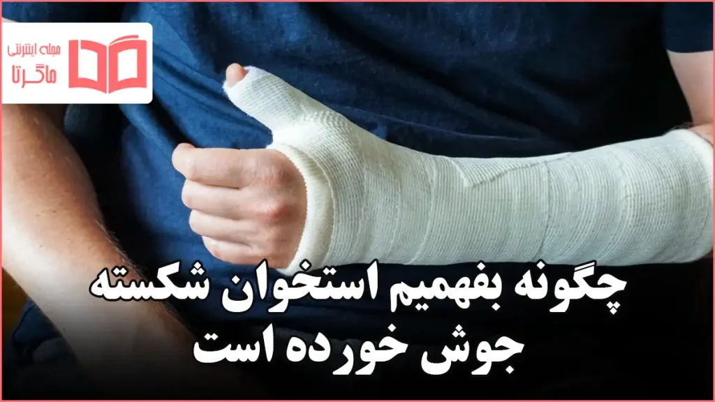 چگونه بفهمیم استخوان شکسته جوش خورده است