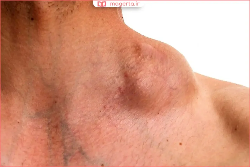 نمایش محل غدد لنفاوی زیر بغل و نشانههای بزرگشدگی