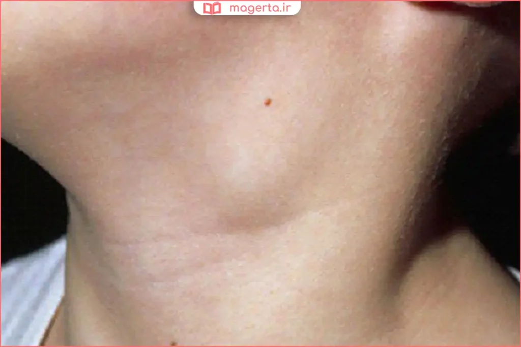 معاینه پزشکی غدد لنفاوی برای تشخیص علت تورم