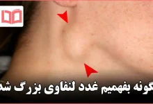 چگونه بفهمیم غدد لنفاوی بزرگ شده