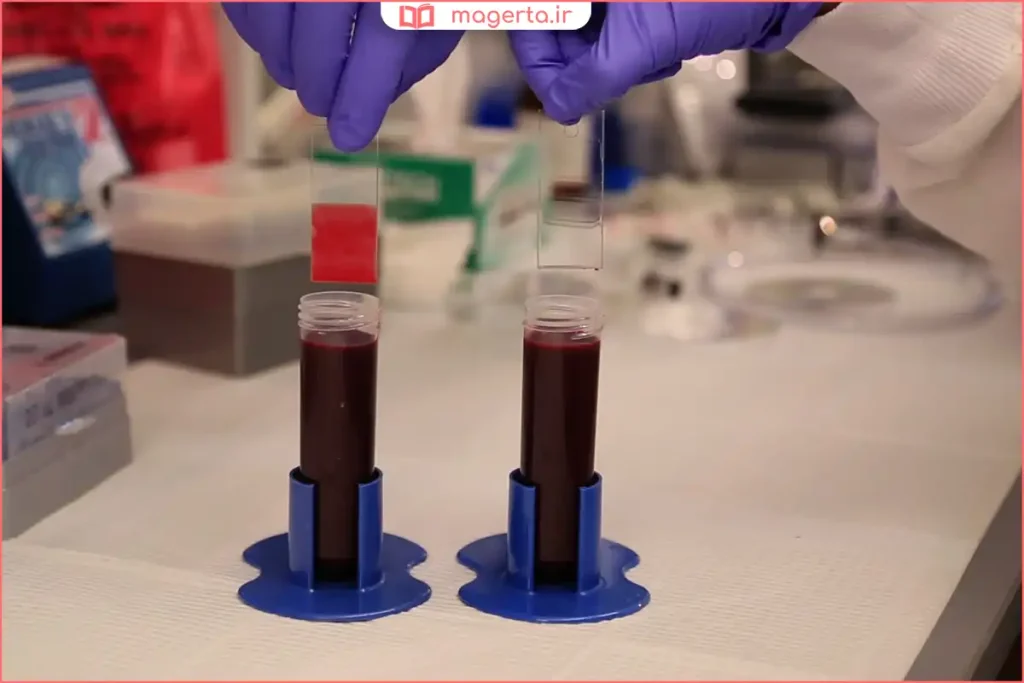 نمونهگیری خون در آزمایشگاه برای تشخیص غلظت خون